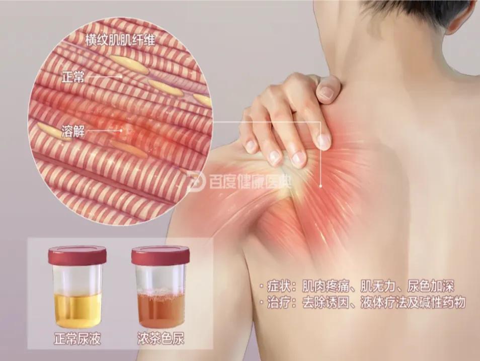 MK体育登录入口-警惕！小心这些药正在“溶解”你的肌肉